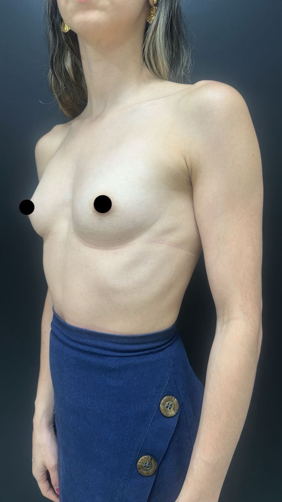 Mamoplastia de aumento — antes