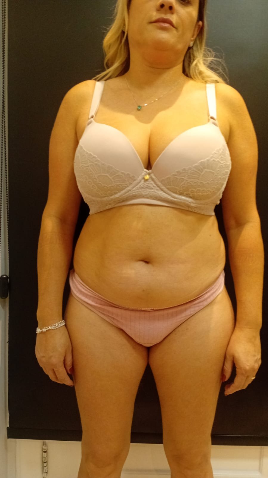 Abdominoplastia + Lipo — antes