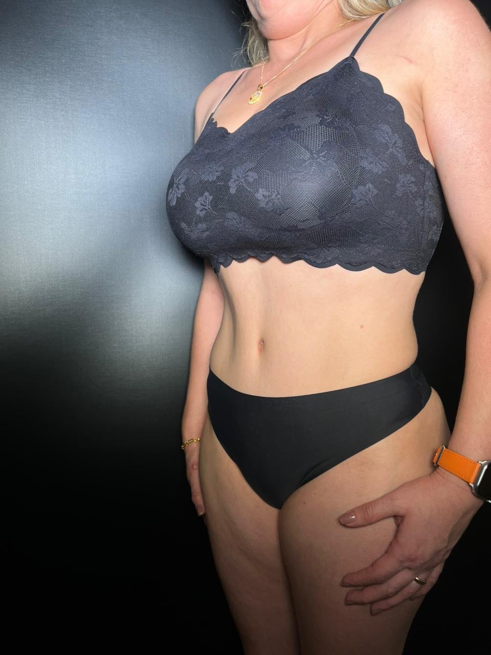 Abdominoplastia + Lipo — depois